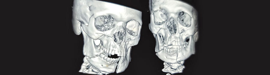 Facial Fracture