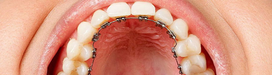 Lingual orthodontics