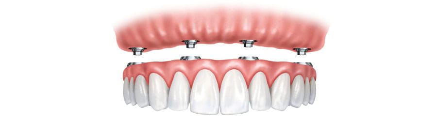 Implant Supported Tooth